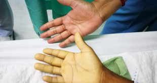 Anaemia