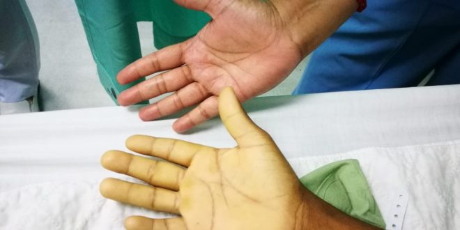 Anaemia